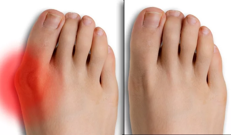 What is a Bunion? 