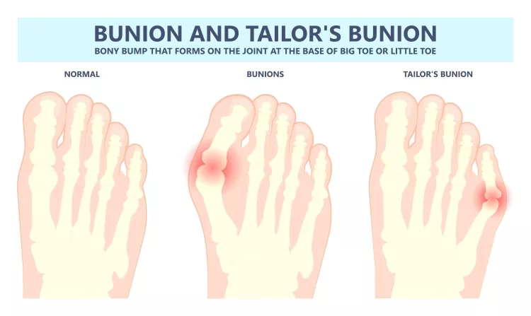 Causes Of a Bunion