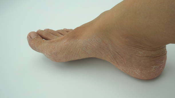 Skin Fissure Ball Of Foot