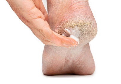 Cracked Skin On Big Toe Remedy