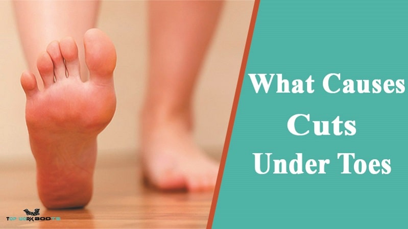 What Causes Cuts Under Toes
