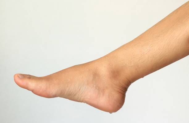 How To Stop Feet Sweating